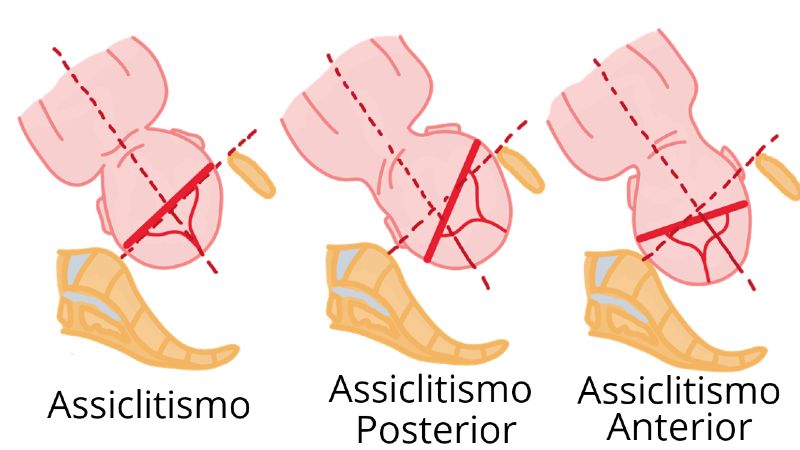 Assiclitismo - Cesárea – Quando Realmente é Indicação